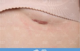 疤痕修复术 疤痕修复手术