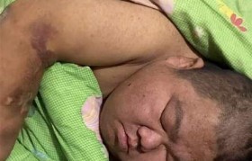 泡泡龙病 泡泡龙病能不能打新冠疫苗