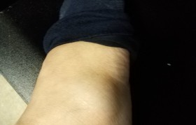 脚崴到了怎么办 脚踝崴了肿了怎么办