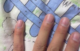 灰指甲早期症状图 灰指甲早期症状图片集