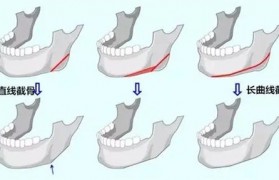 削骨手术 削骨手术从哪里开刀