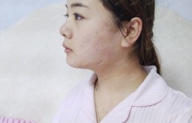 双下巴吸脂术 改善下巴后缩自然方法