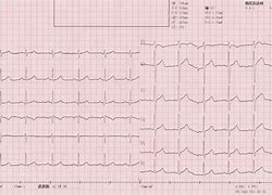 心电图图片 心电图图片位置图