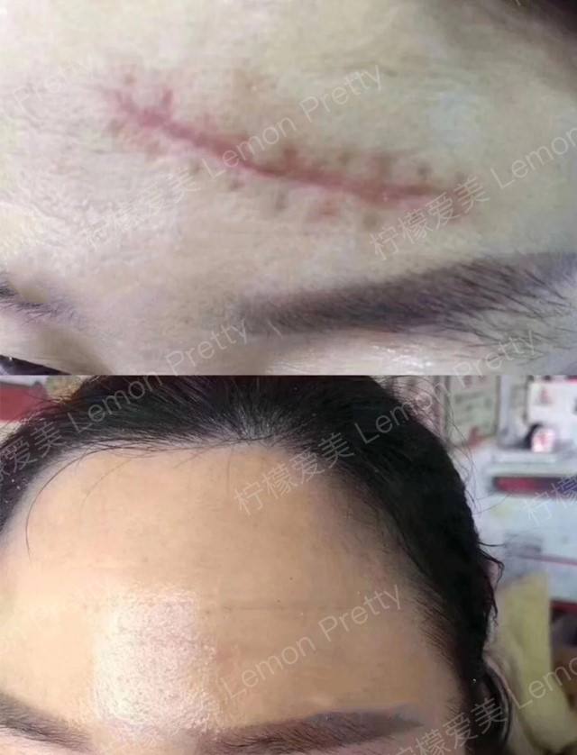 疤痕修复术 疤痕修复手术 疤痕修复术 疤痕修复手术
