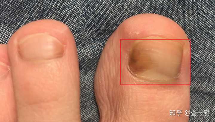 灰指甲早期症状图 灰指甲早期症状图片集