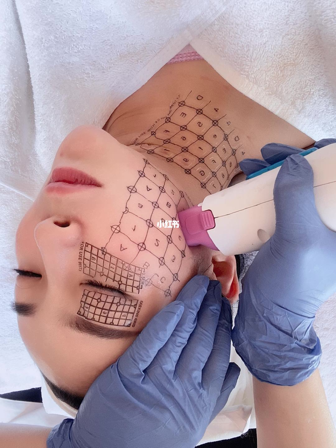 什么是热玛吉 医美热玛吉是什么东西