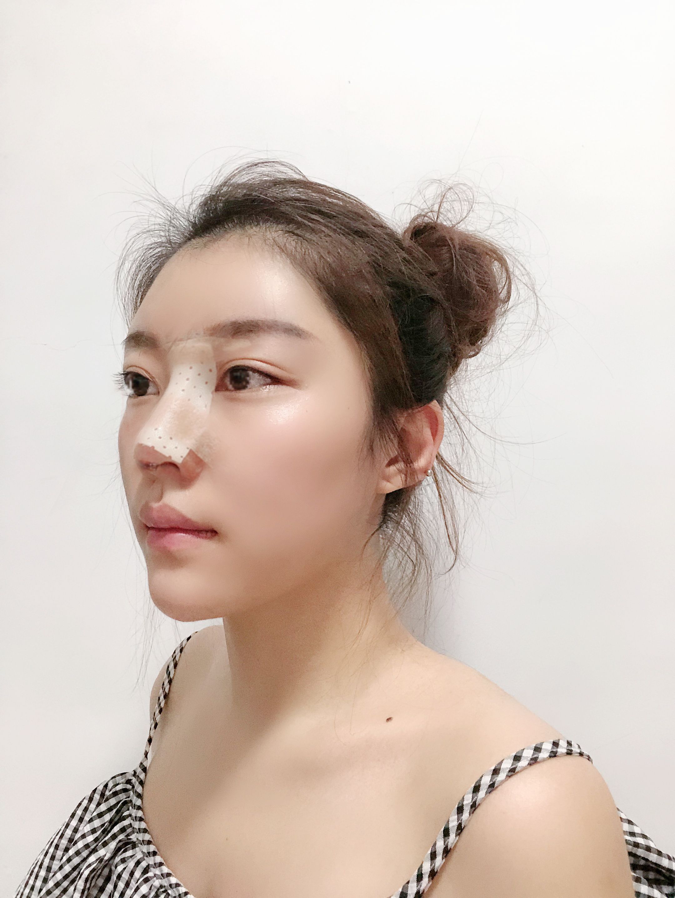 修复隆鼻 修复隆鼻价格