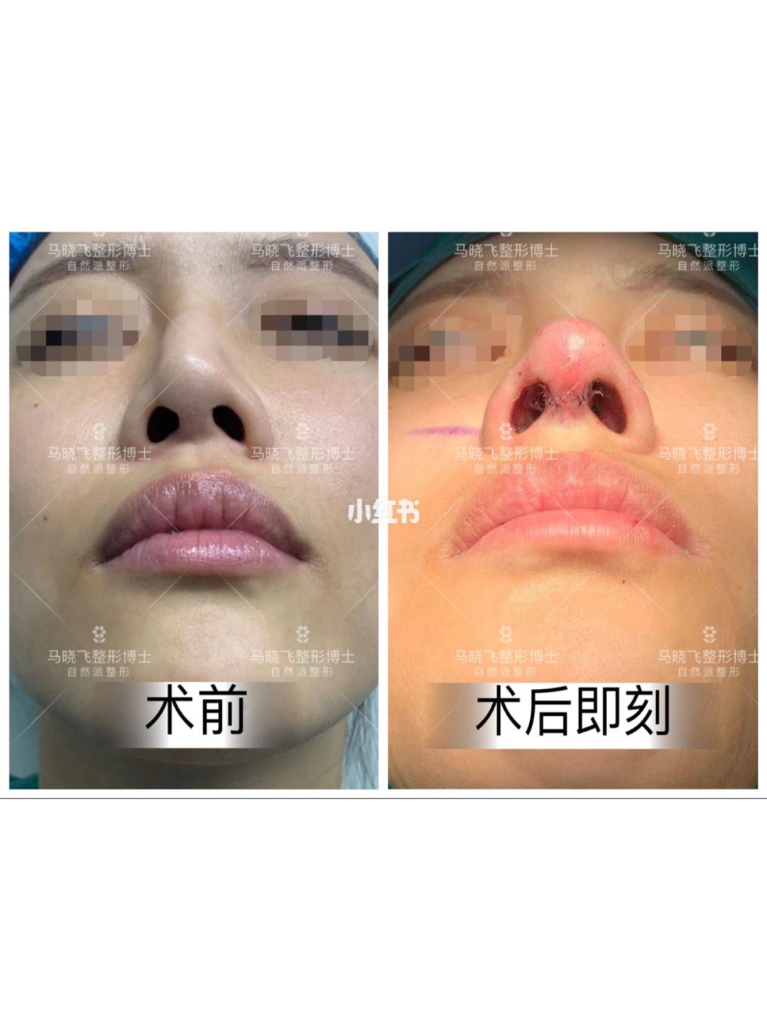 修复隆鼻 修复隆鼻价格