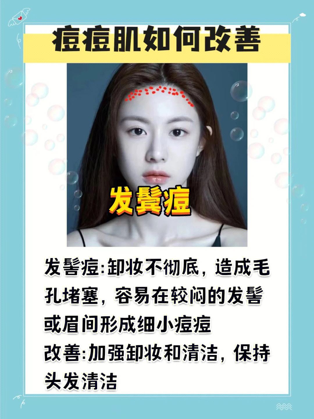 痘痘肌肤怎么改善 男生痘痘肌肤怎么改善