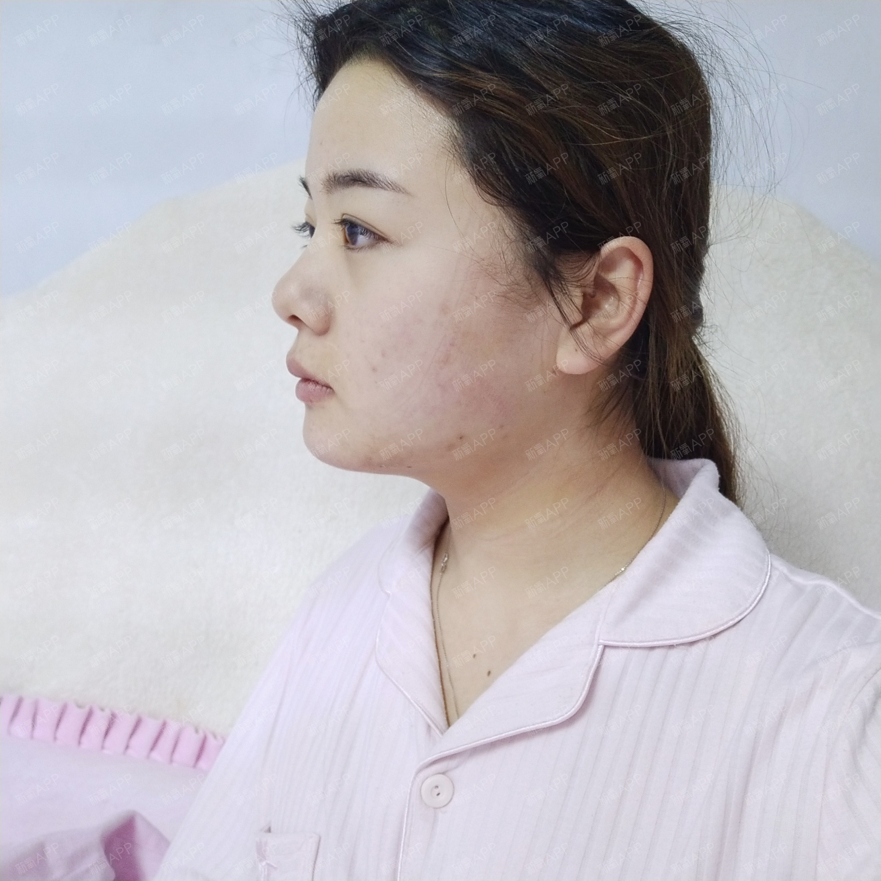 双下巴吸脂术 改善下巴后缩自然方法