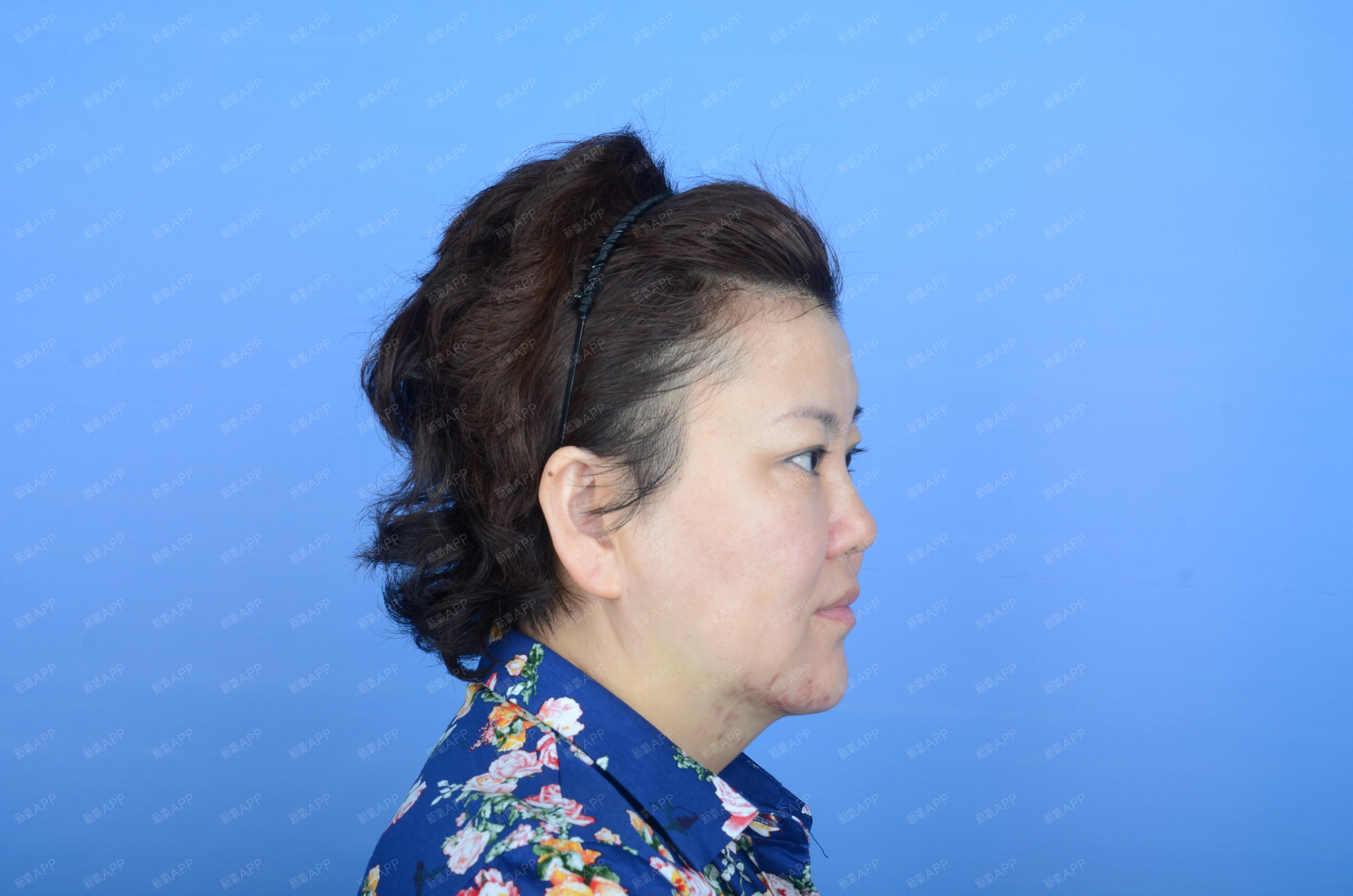 双下巴吸脂术 改善下巴后缩自然方法