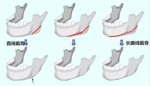 削骨手术 削骨手术从哪里开刀