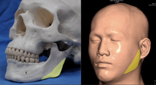 削骨手术 削骨手术从哪里开刀