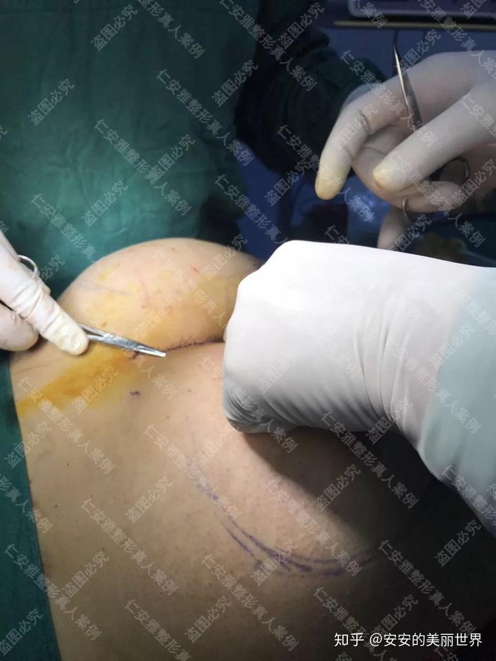 丰臀 丰臀后遗症