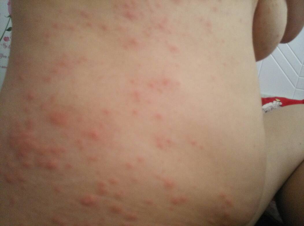 湿疹太痒了怎么办 湿疹晚上特别痒怎么办