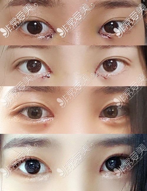 开眼角对比图 内双开眼角对比图