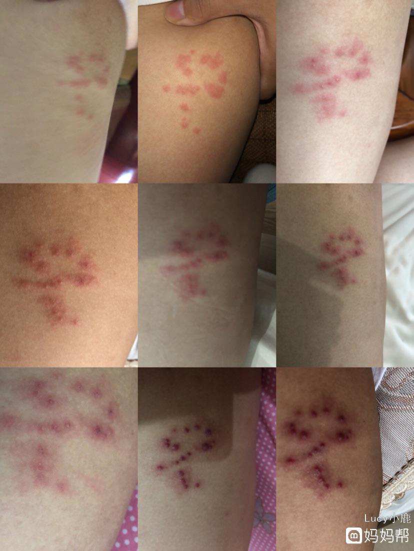 蜘蛛疮是春季最流行的一种病毒性皮肤病,蜘蛛疮由水痘带状疱疹病毒的