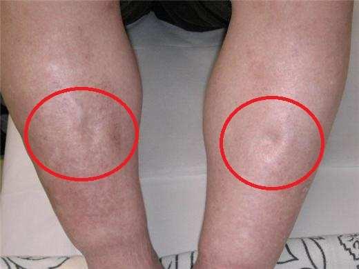 水肿怎么办消得快 经期水肿怎么办消得快