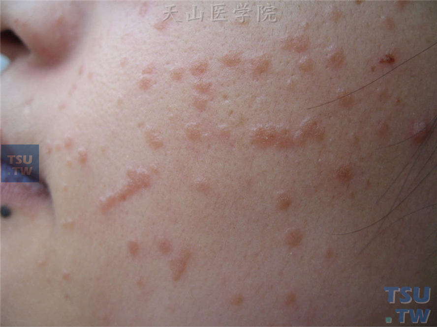 扁平疣的症状图片 怎么确定是不是扁平疣